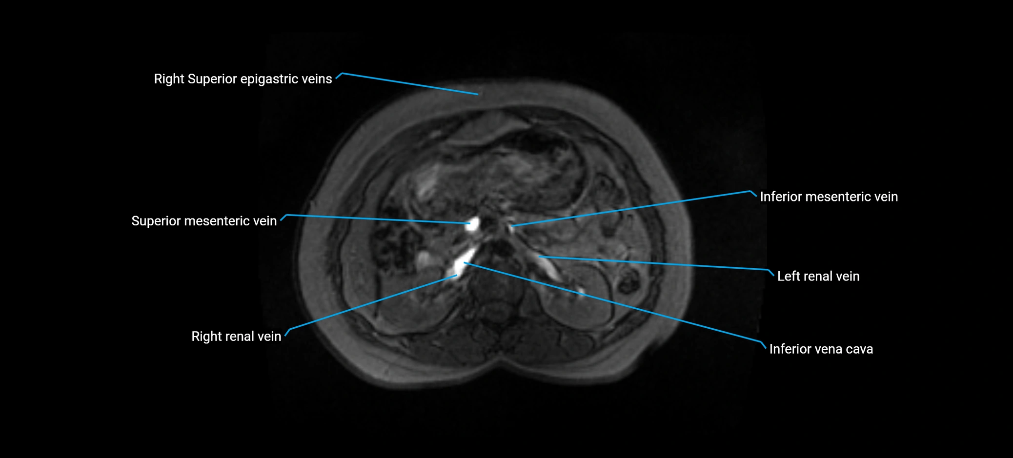MRV abdomen pelvis & lower limb axial cross sectional anatomy labelled MRI image 63 (1).webp